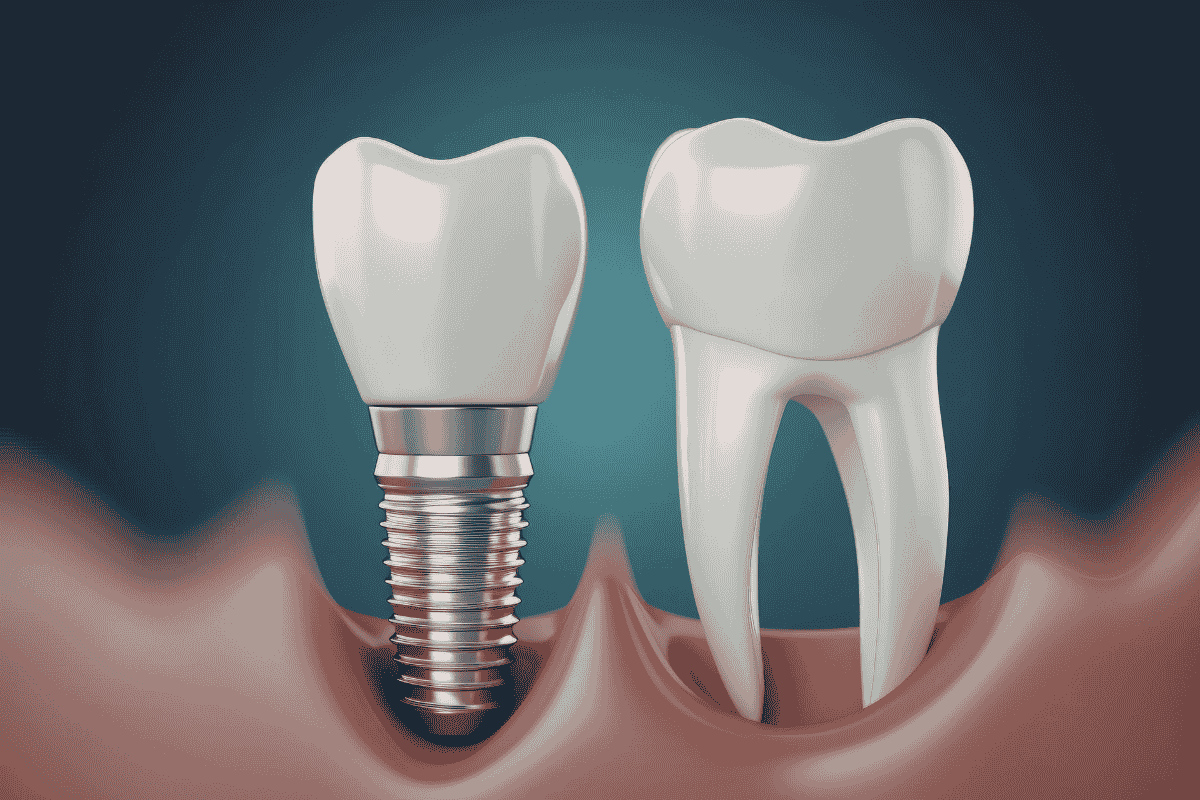 Dental implant procedure
