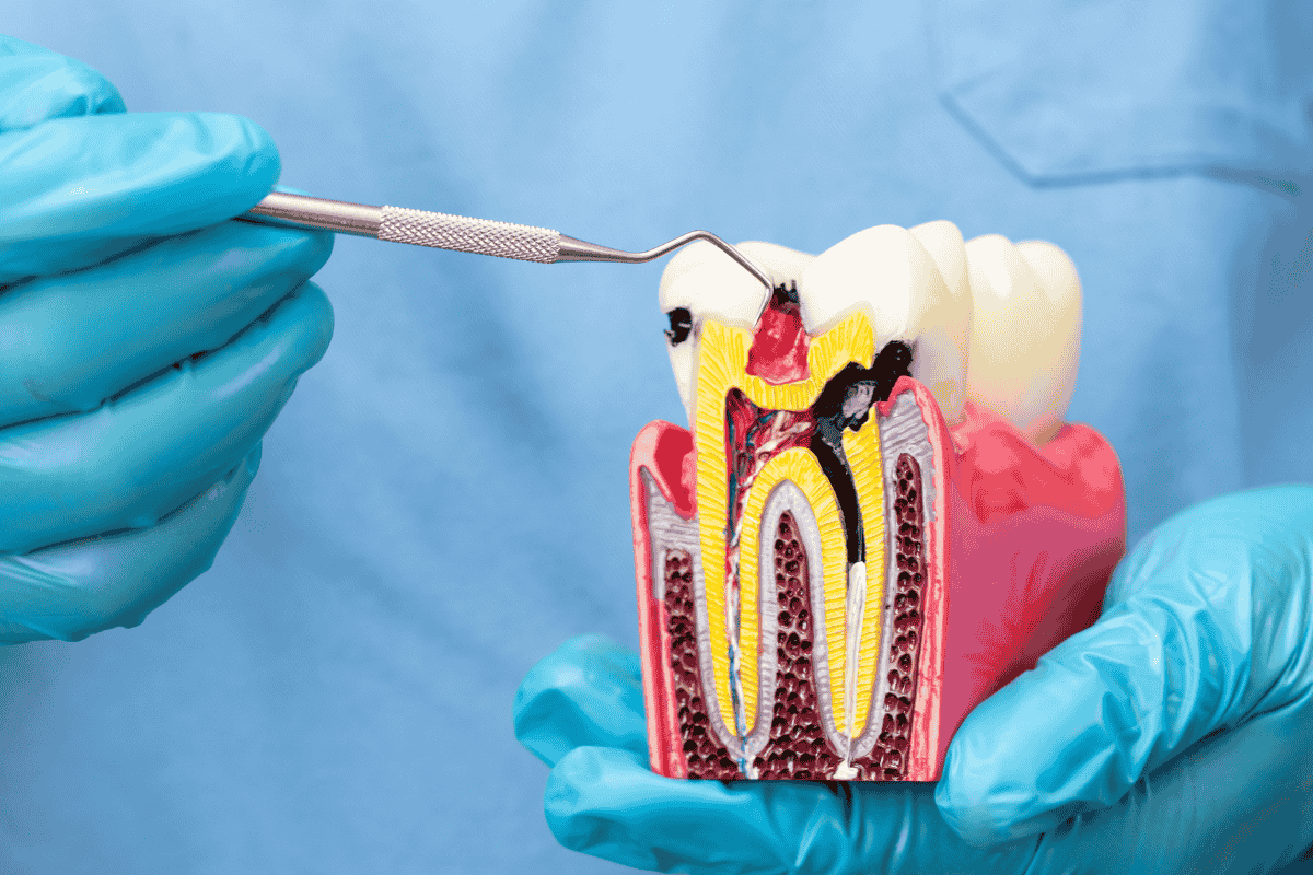 Root canal procedure