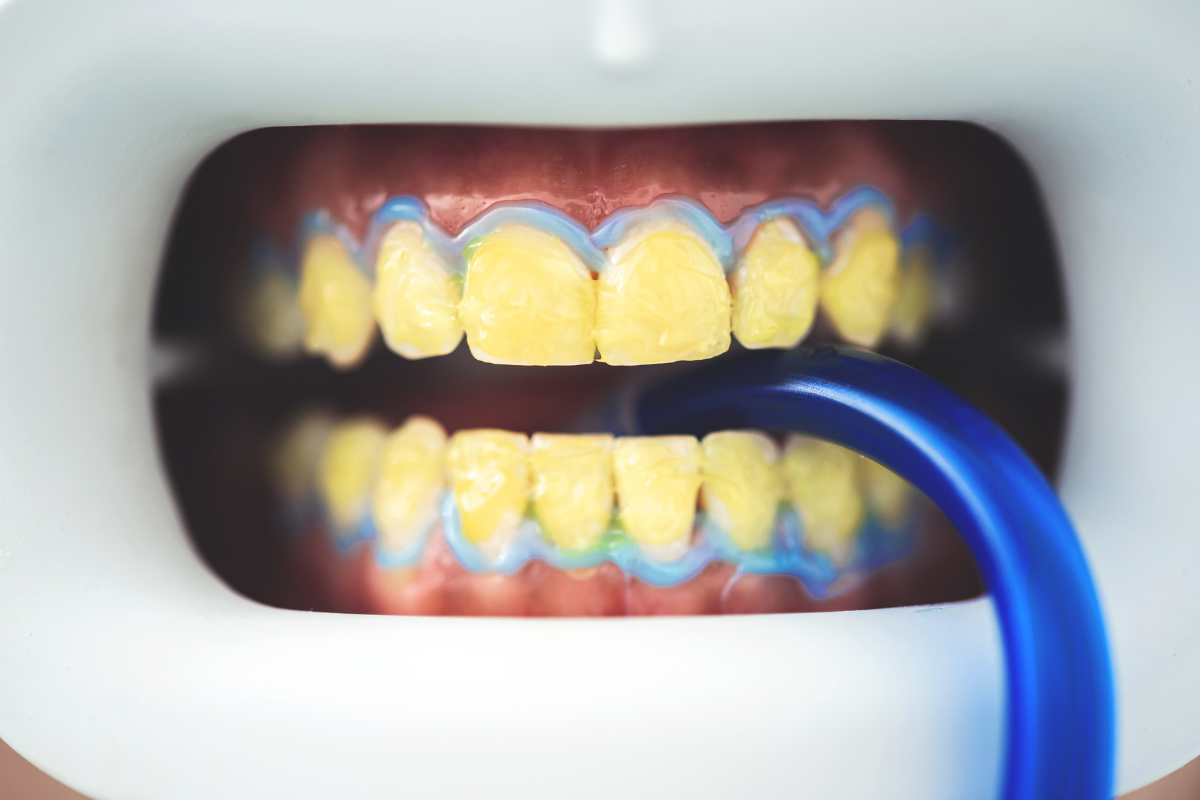 Teeth bleaching treatment