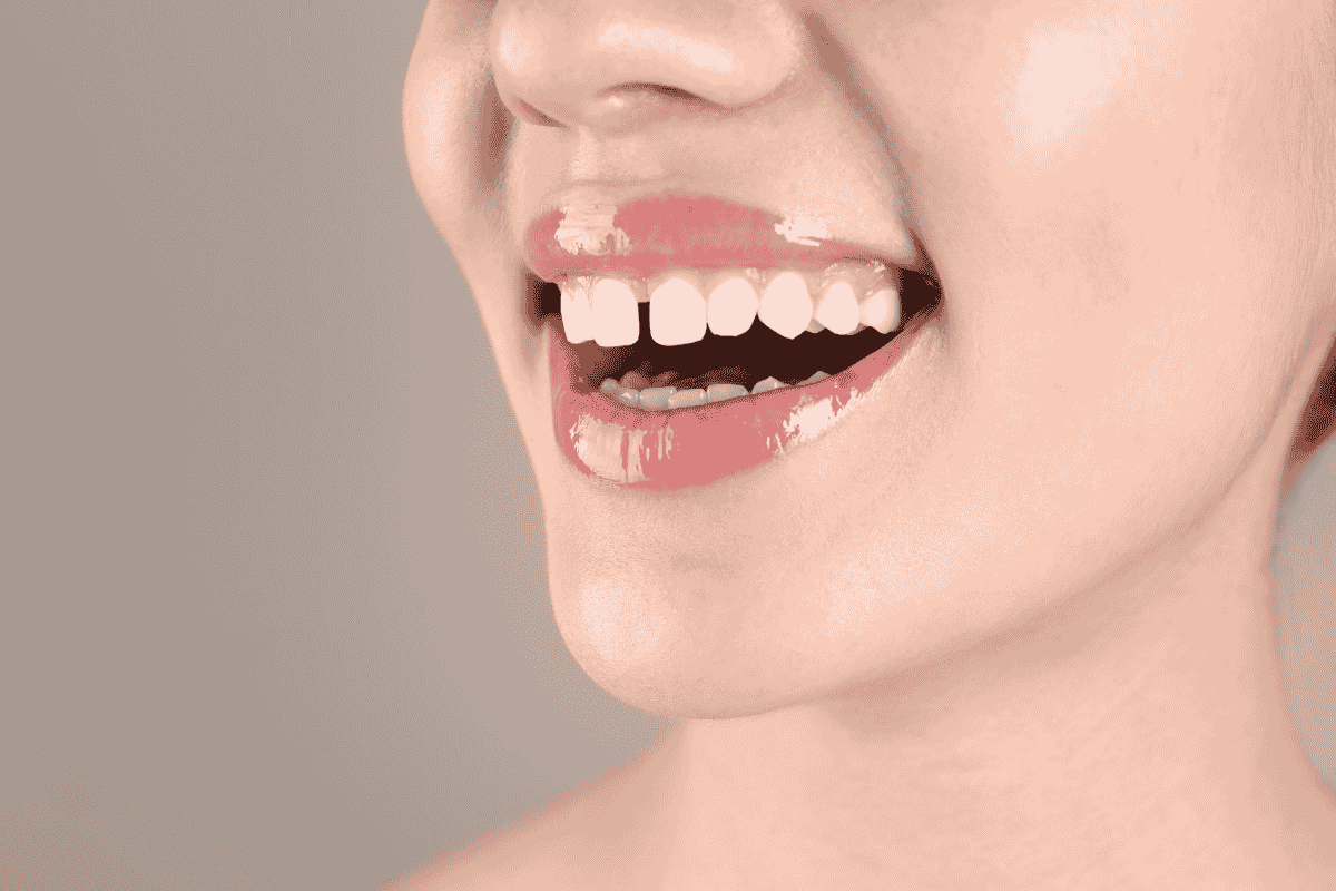 Teeth gap closure treatment